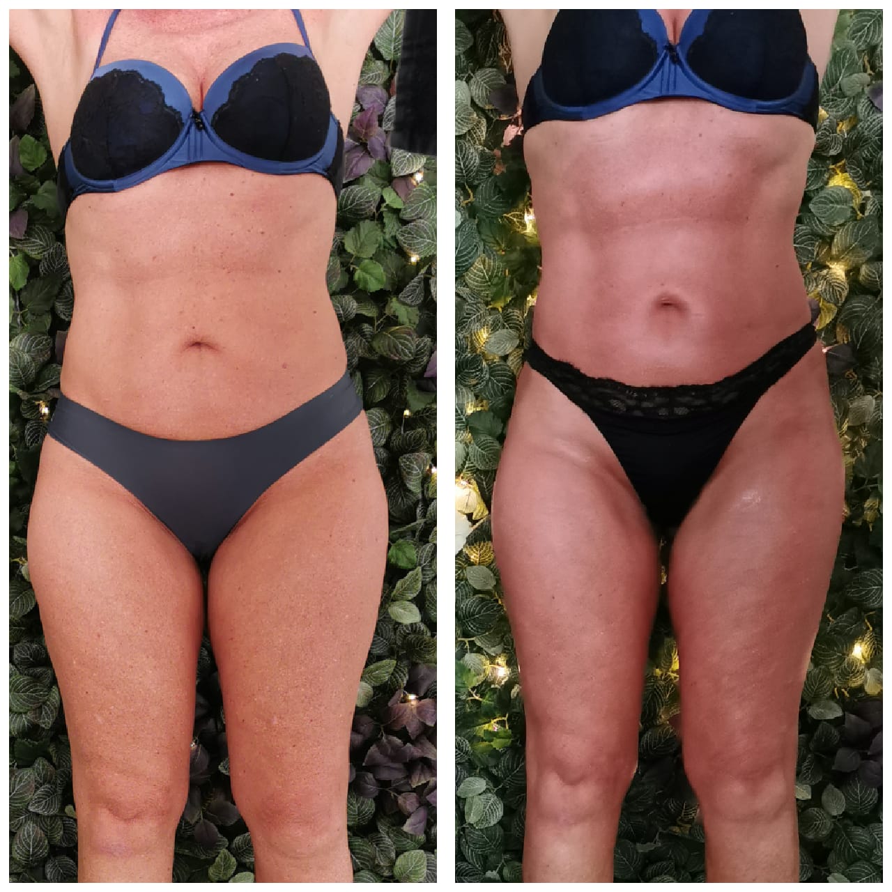 Verstrakken taille Mesoestetic Bodyshock